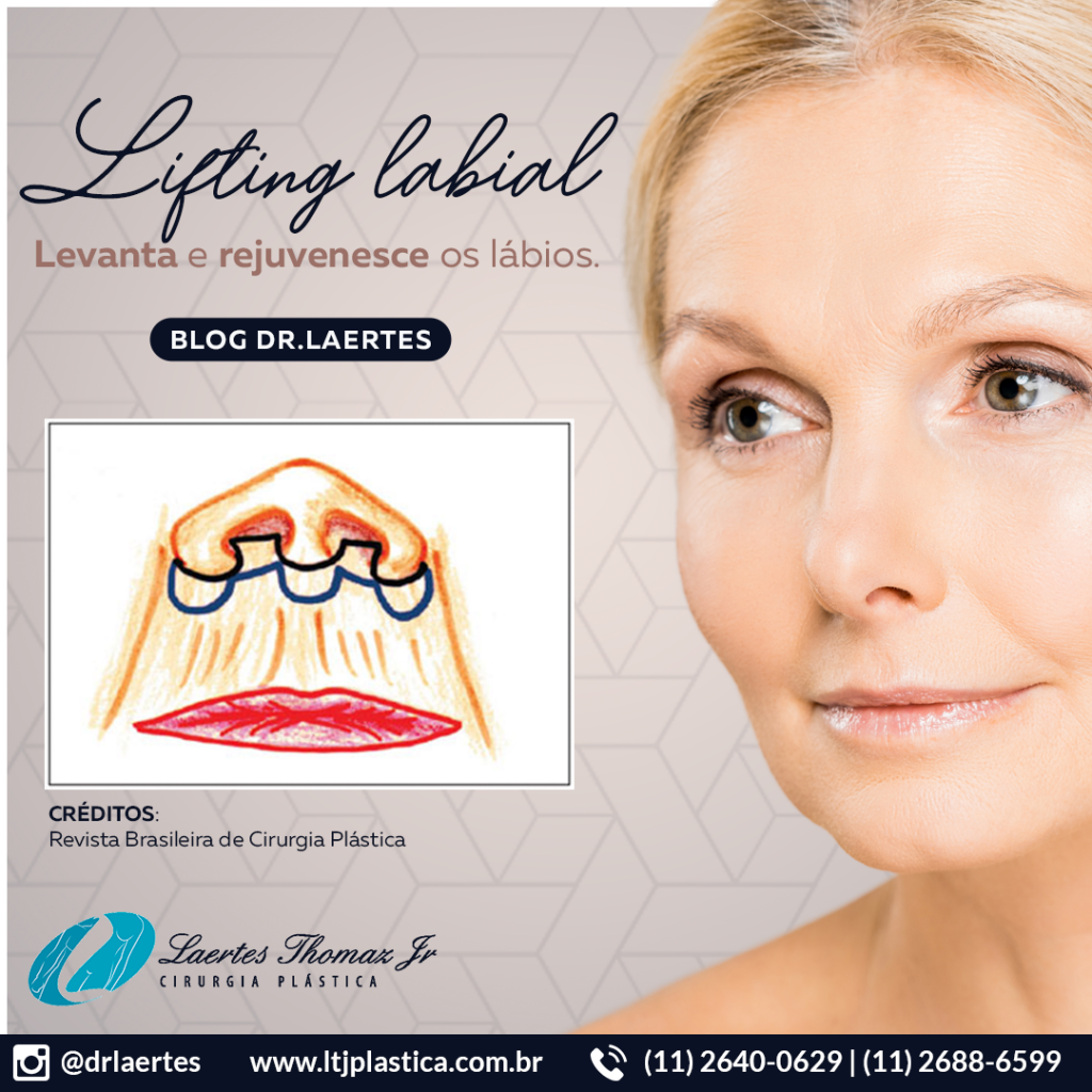 lifting labial