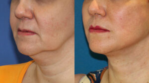 cirurgia plástica são paulo lifting facial